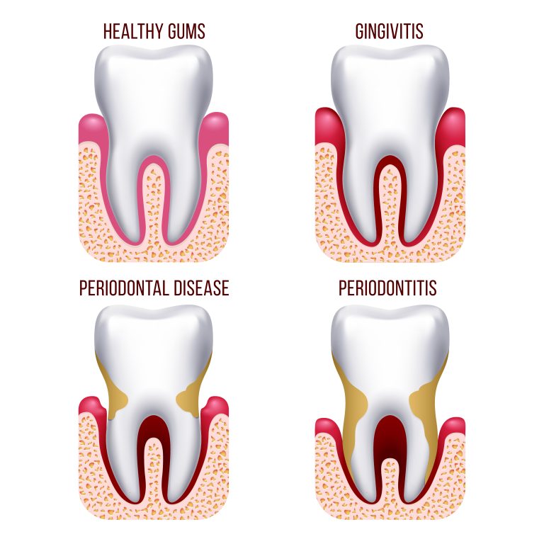 Human gum disease, gums bleeding. Tooth prevention dental, oral care vector infographics