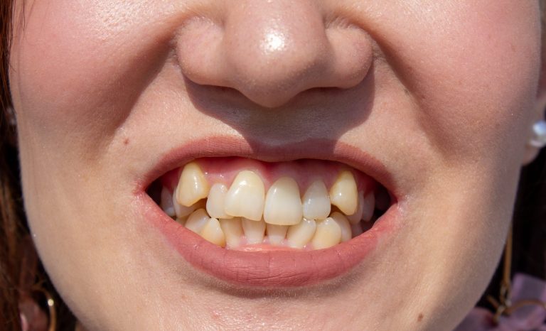 Curved female teeth, before installing braces. Close - up of teeth before treatment by an orthodontist.