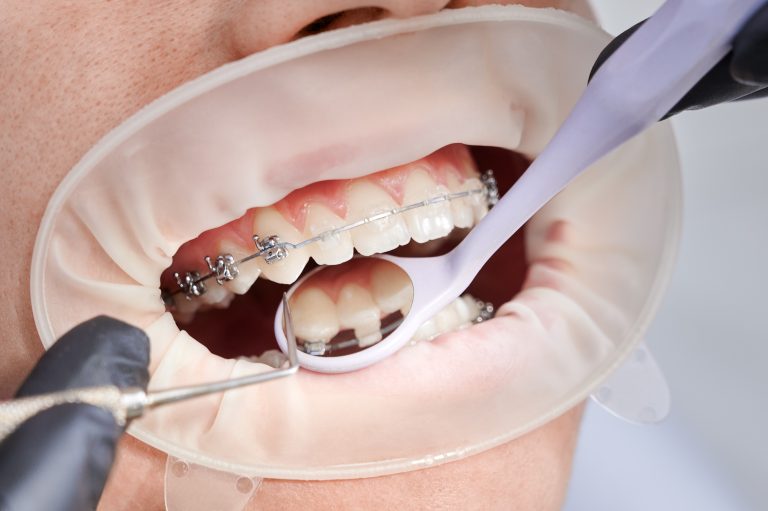 Close up of orthodontist placing orthodontic brackets on patient teeth. Person with cheek retractor and metal braces on teeth having dental procedure in clinic. Concept of orthodontic treatment.