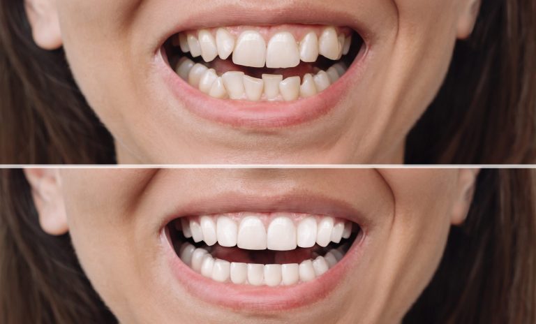 woman-before-after-veneers-installation-correction-uneven-teeth-with-braces