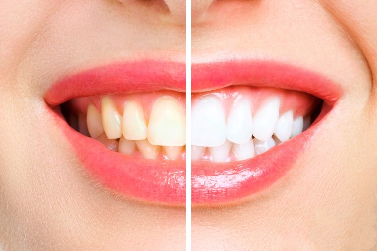 woman teeth before and after whitening. Over white background. Dental clinic patient. Image symbolizes oral care dentistry, stomatology.